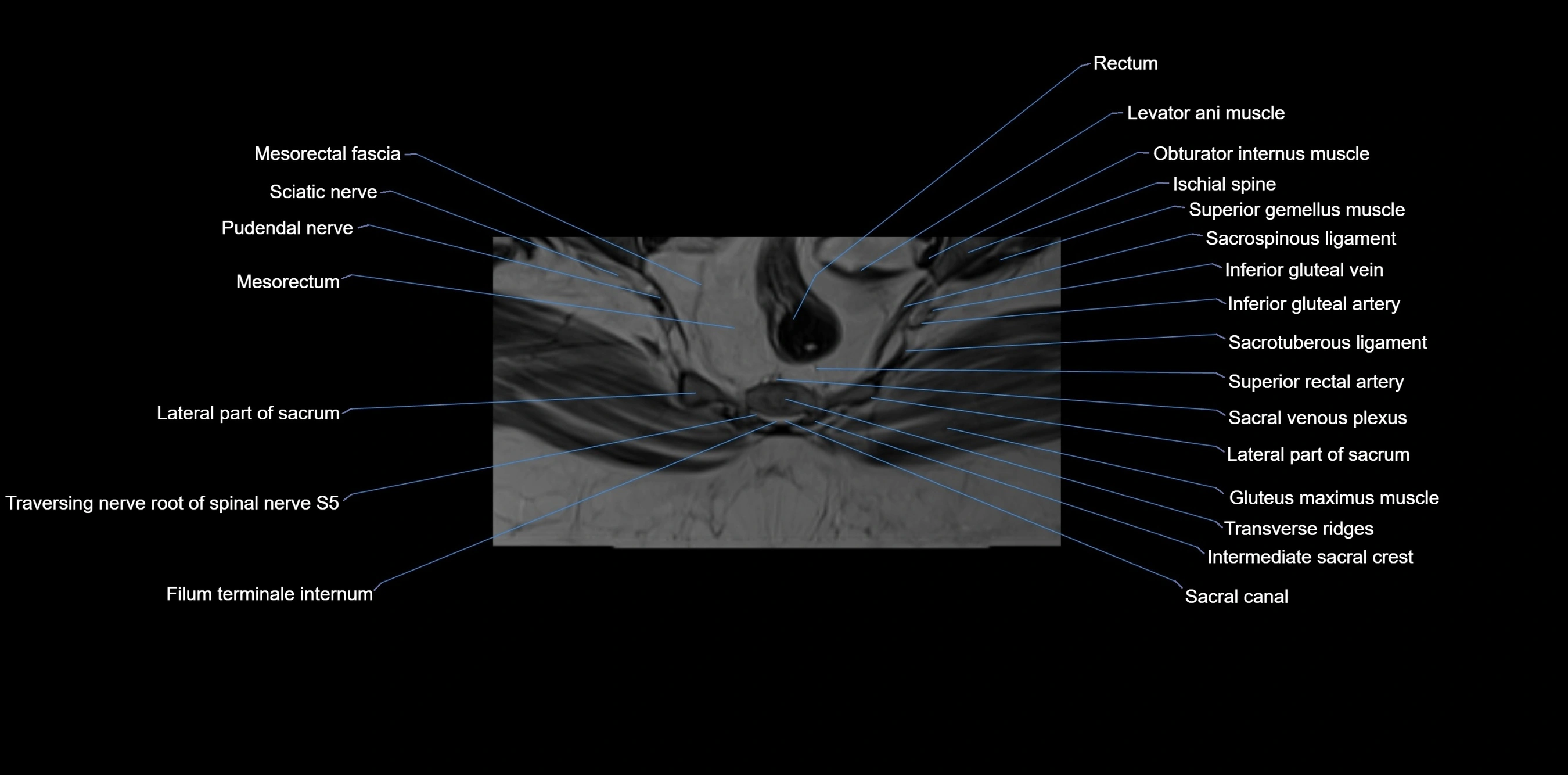 MRI sacrum, coccyx and sacroiliac joint axial cross sectional anatomy 3T  radiology  image-img-00001-00055.webp